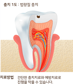 충치 1도 : 법랼질 충치 치료방법 간단한 충치치료와 예방 치료로 진행을 막을수 있습니다.