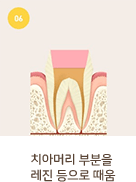 치아머리 부분을 레진 등으로 때움