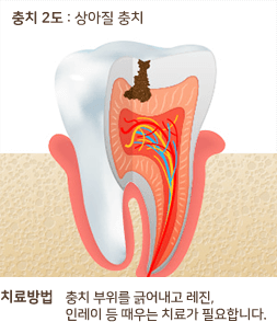 충치 2도 : 상아질 충치 치료방법 충치 부위를 긁어내고 레진, 인레이 등 때우는 치료가 필요합니다.