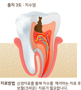 충치 3도 : 치수염 치료방법 신경치료를 통해 치수를 제거하는 치료 후 보철(크라운) 치료가 필요 합니다.