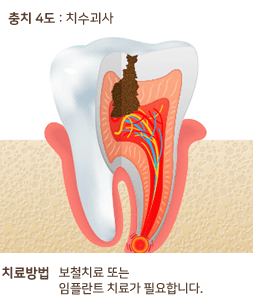 충치 4도 : 치수괴사 치료방법 보철치료 또는 임플란트 치료가 필요 합니다.