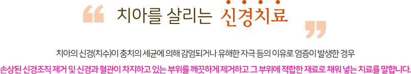 치아를 살리는 신경치료 치아의 신경(치수)이 충치의 세균에 의해 감염되거나 유해한 자극 등의 이유로 염증이 발생한 경우 손상된 신경조직 제거 및 신경과 혈관이 차지 하고 있는 부위를 깨끗하게 제거하고 그 부위에 적합한 재료로 채워 넣는 치료를 말합니다.